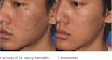 PRPTreatment for acne