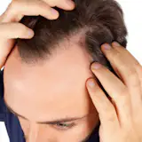 PRPTretament for hairfall